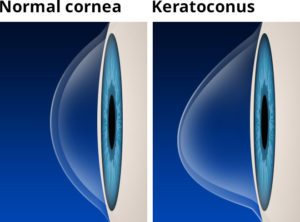 keratoconus-with-labels-660x488