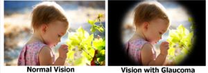 vision-with-and-without-glaucoma