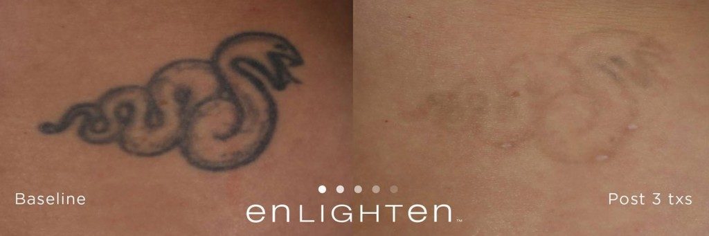 Full removal update 5 months after 6th and final session with Cutera  Enlighten laser : r/TattooRemoval