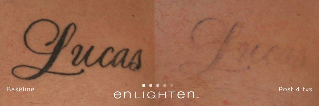 Tackle tough ink faster with the enlighten III by Cutera.  @burlingtonmedicalaesthetics demonstrates how fast and effective tattoo  removal… | Instagram