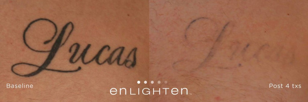 Laser Tattoo Removal Treatment  Tattoo Correction  CUTERA